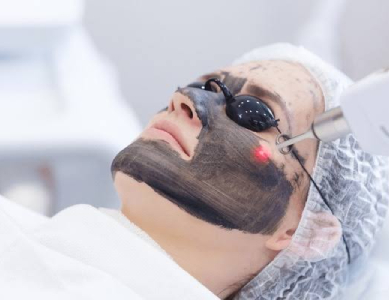 Carbon Laser Facial